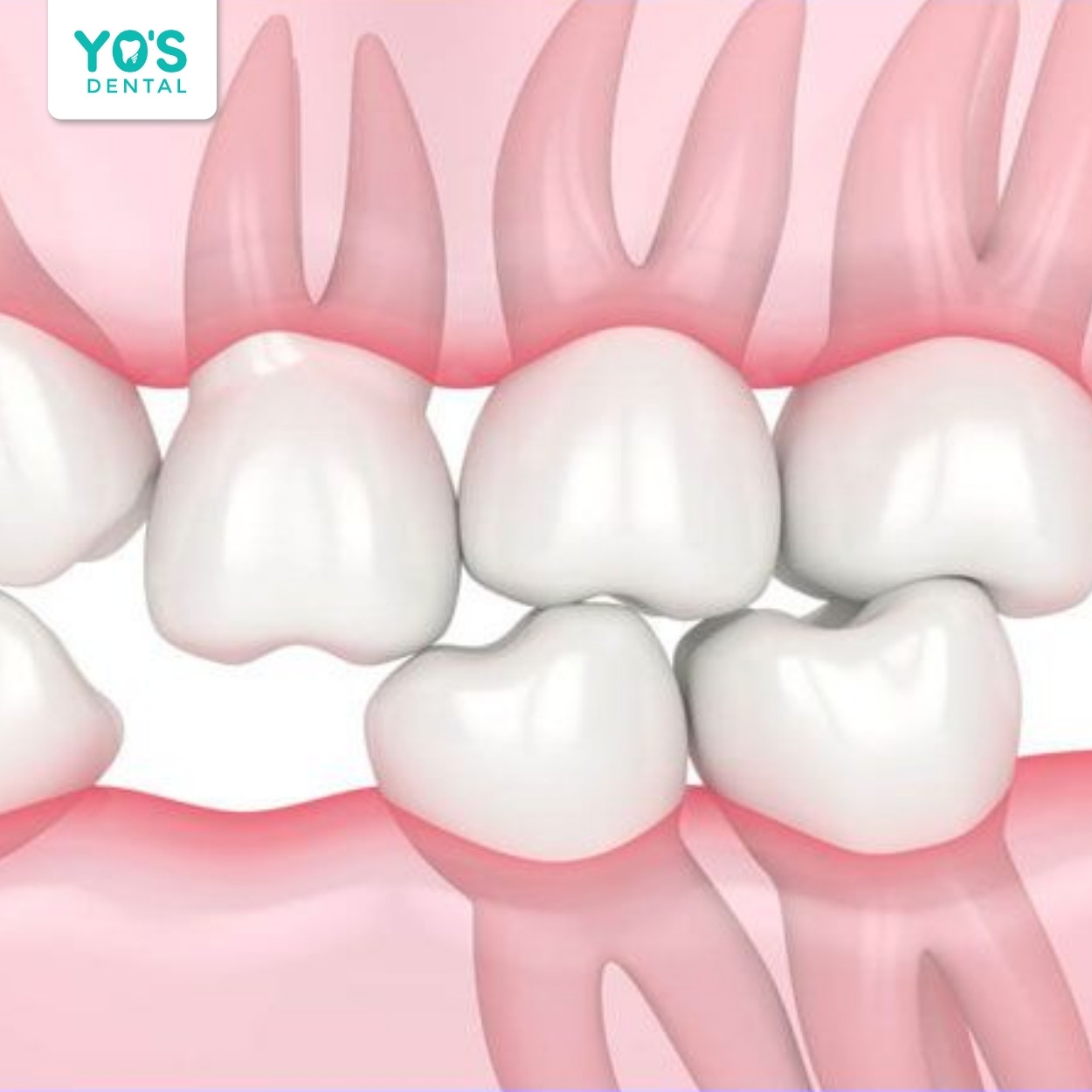 Răng bị xô lệch do mất răng