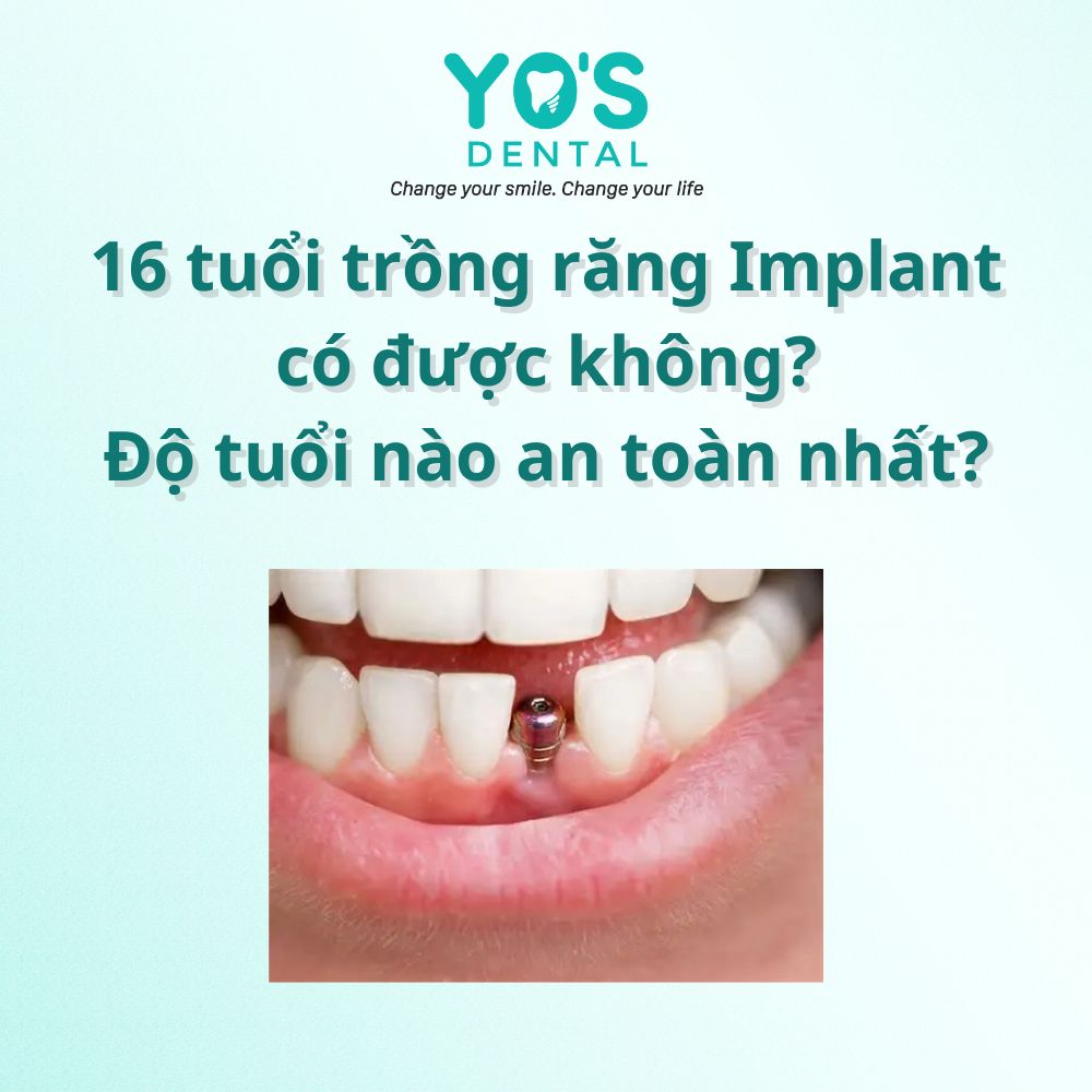 16 tuổi trồng răng Implant được không? Độ tuổi nào an toàn nhất?