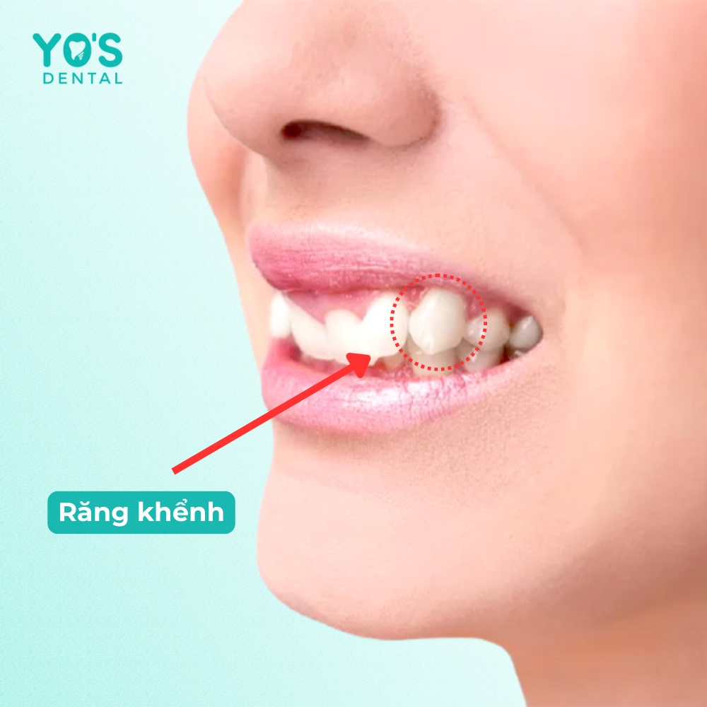 Sơ đồ nha khoa chỉ rõ vị trí răng số 3 bị mọc lệch