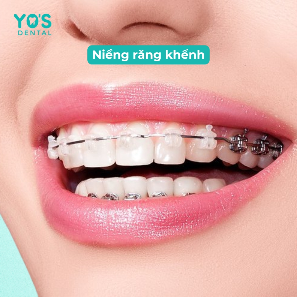Niềng răng - Giải pháp tối ưu để bảo tồn răng gốc