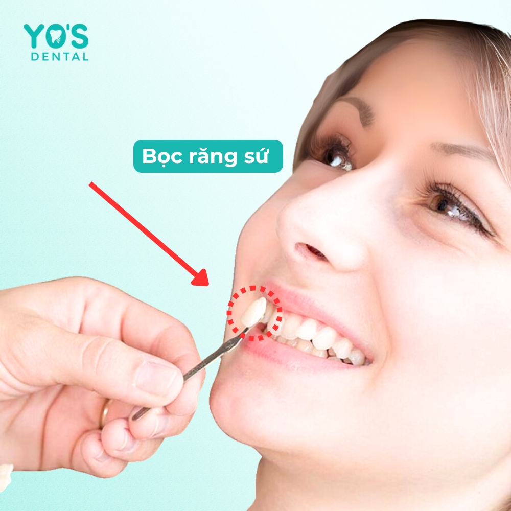 Bọc răng sứ - Cải thiện thẩm mỹ nhanh chóng