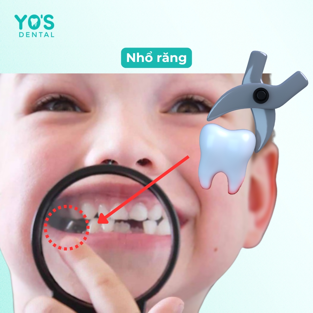 Nhổ răng khểnh (Chỉ được chỉ định bởi bác sĩ)