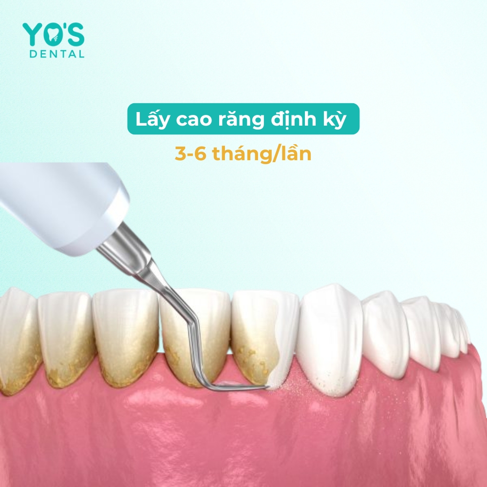 Việc thăm khám và lấy cao răng định kỳ 3-6 tháng/lần là cần thiết