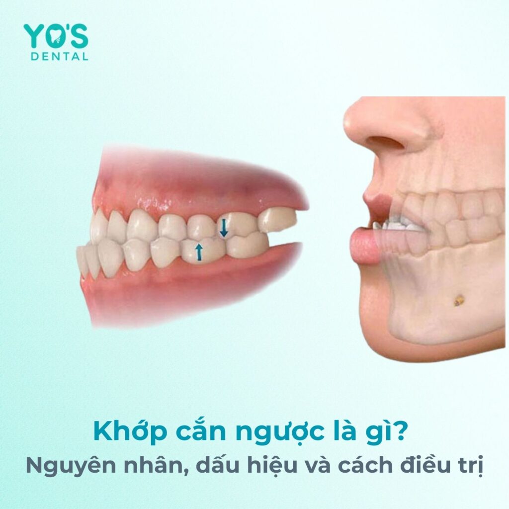 Khớp cắn ngược là gì? Nguyên nhân, dấu hiệu và cách điều trị