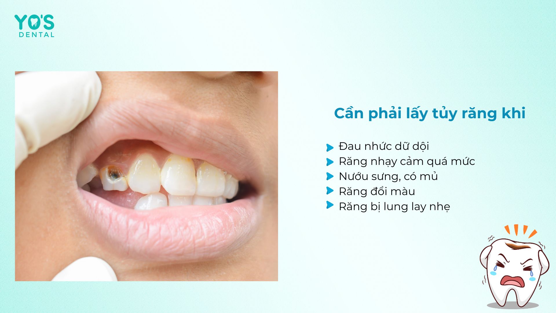 Cần phải lấy tủy răng ngay khi xuất hiện tình trạng đau nhức và bất thường trên răng