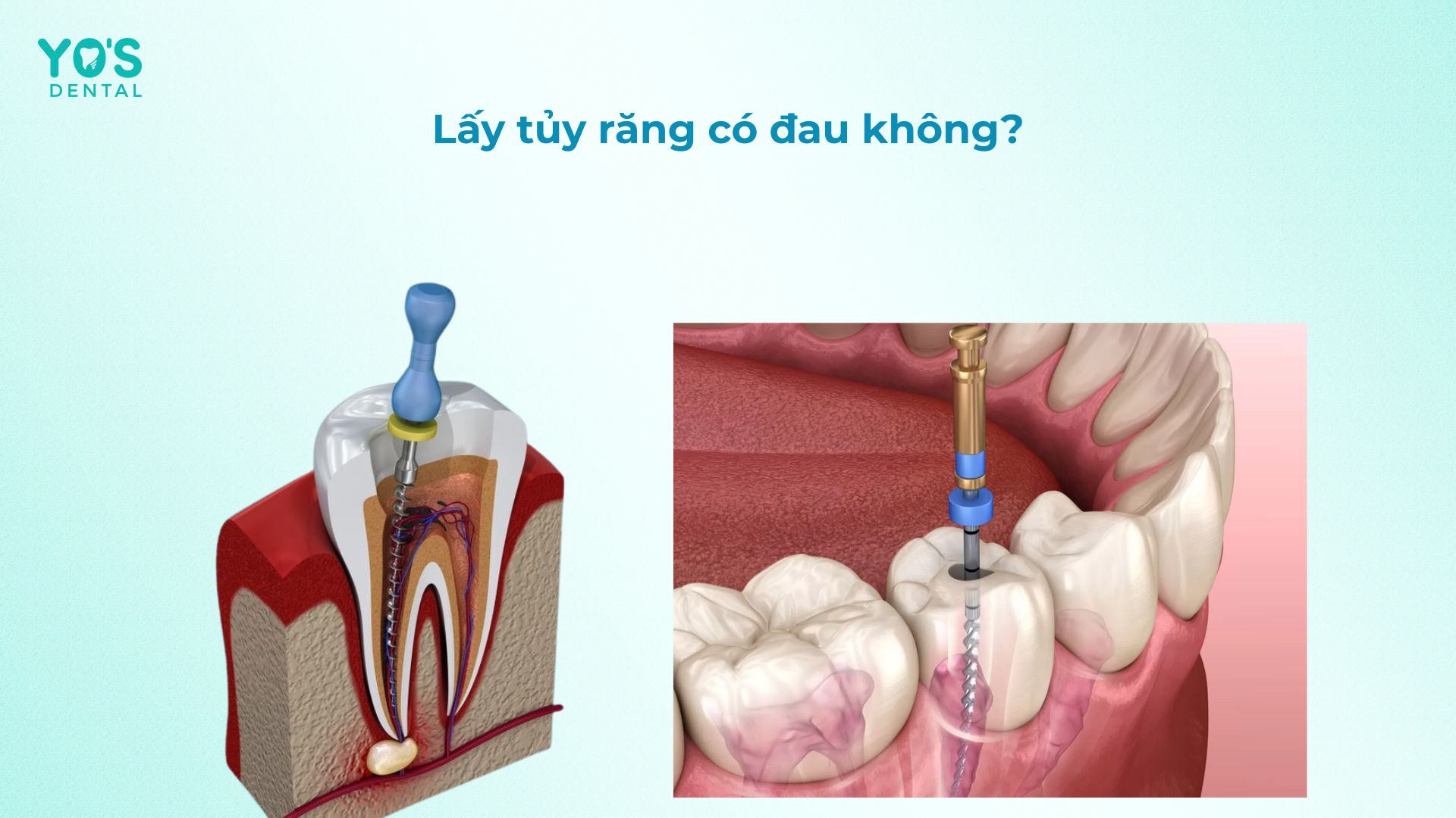 Lấy tủy răng có đau không là câu hỏi thắc mắc chung của nhiều khách hàng