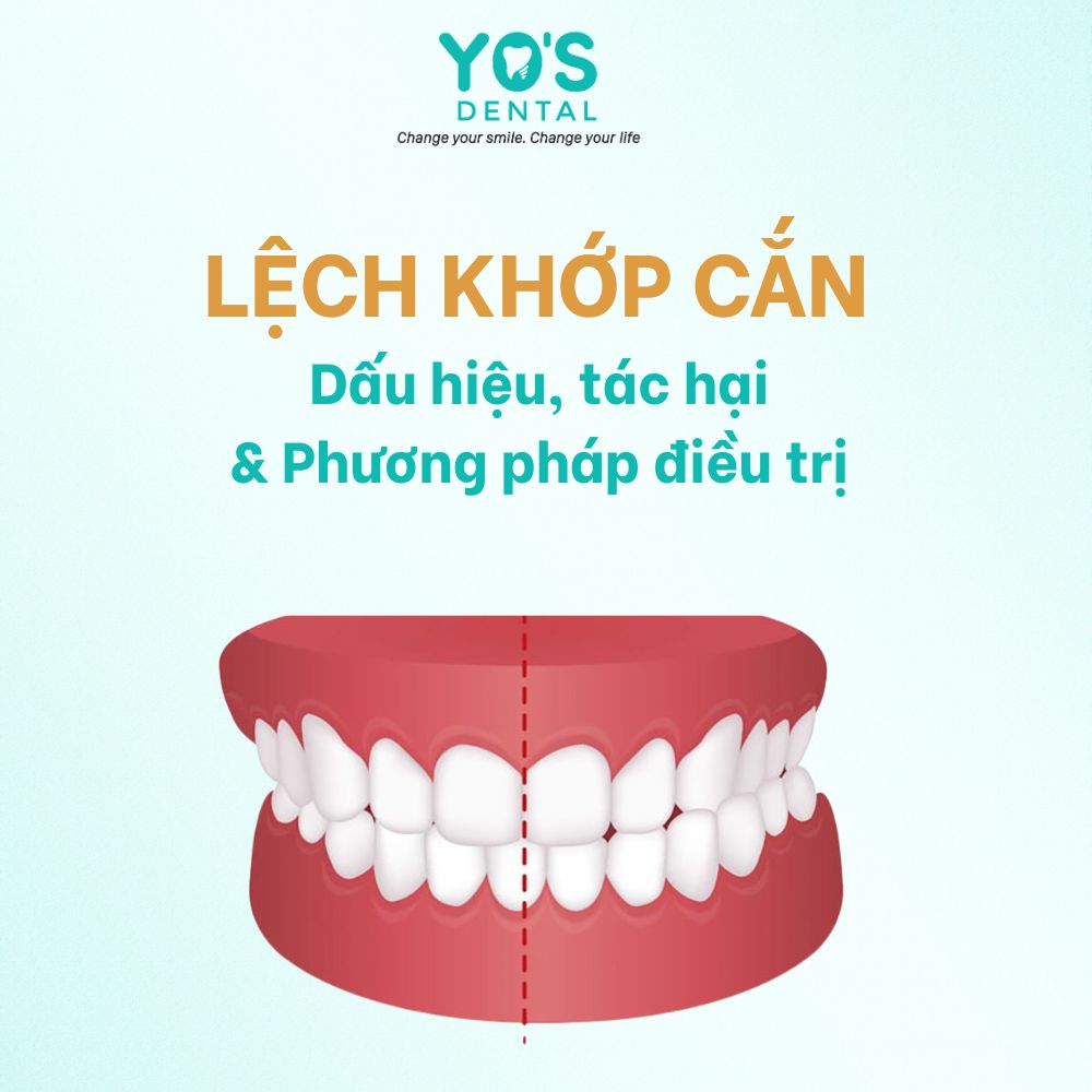 Lệch khớp cắn: Dấu hiệu, tác hại & phương pháp điều trị hiệu quả