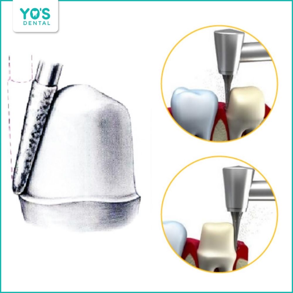 Mài răng bọc sứ tạo cùi răng chuẩn để lắp mão sứ khít và chắc