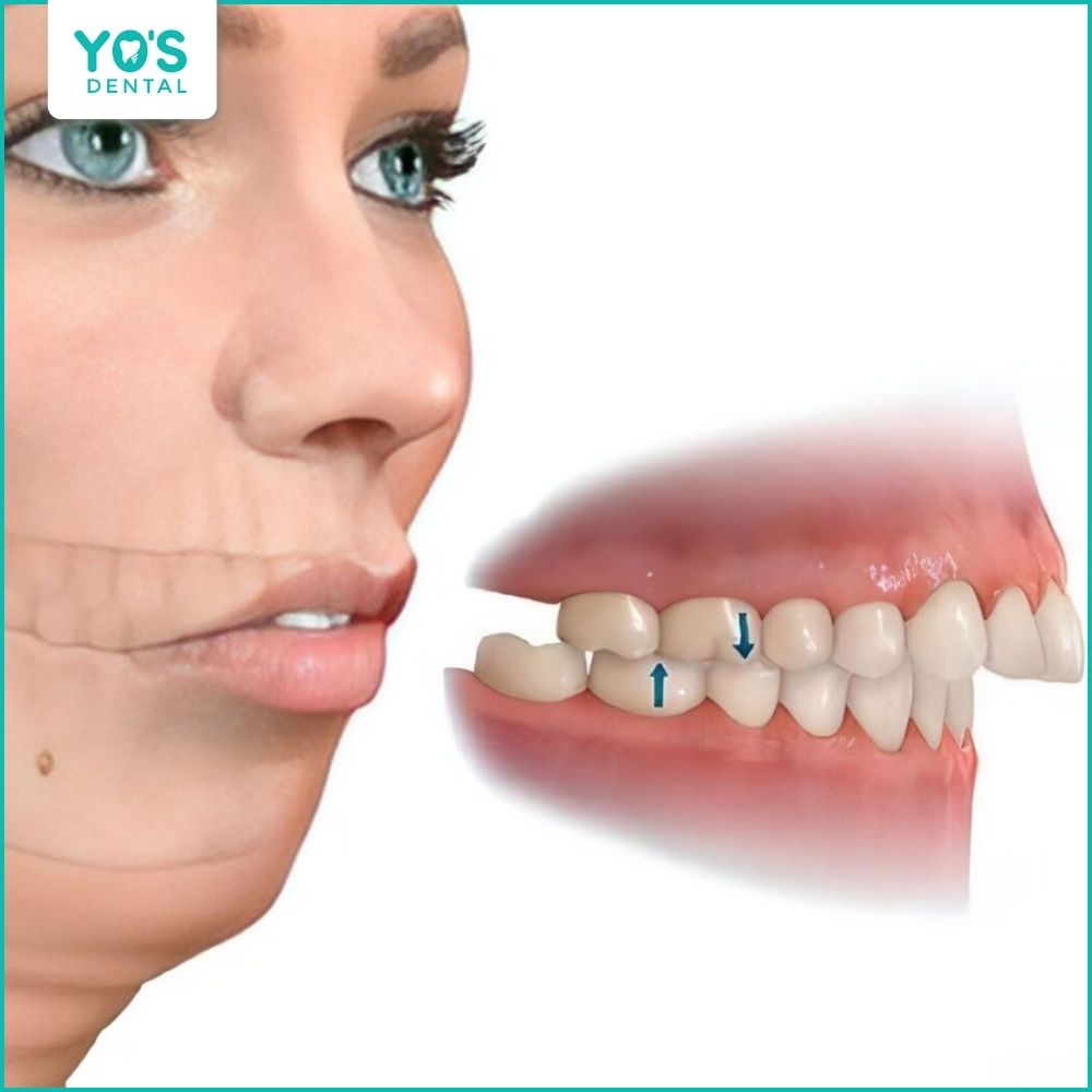 Mài sứ sai khớp cắn gây cộm cấn, mỏi hàm và rối loạn khớp