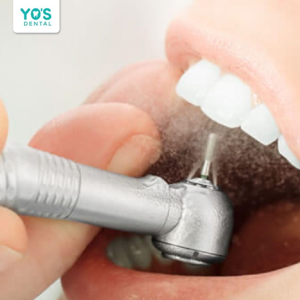 Mão sứ như men răng nhân tạo, bảo vệ và tăng độ bền cho răng