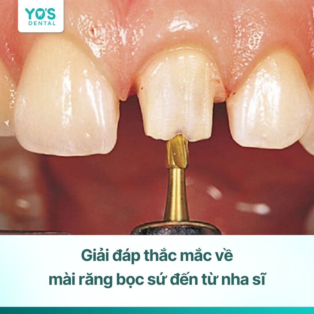 Mài răng bọc sứ: Giải đáp thắc mắc từ A-Z và lời khuyên từ nha sĩ