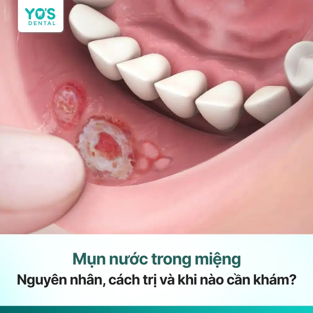 Mụn nước trong miệng: Nguyên nhân, cách trị và khi nào cần khám?