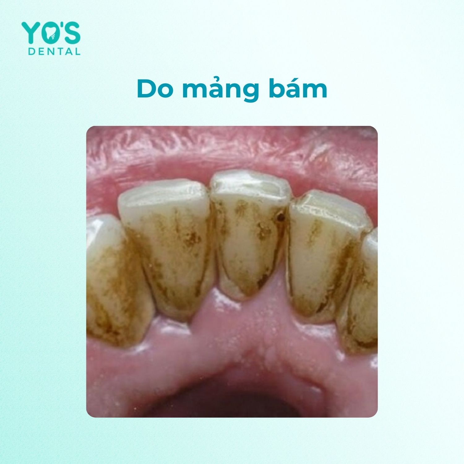 Chân răng bị đen do mảng bám