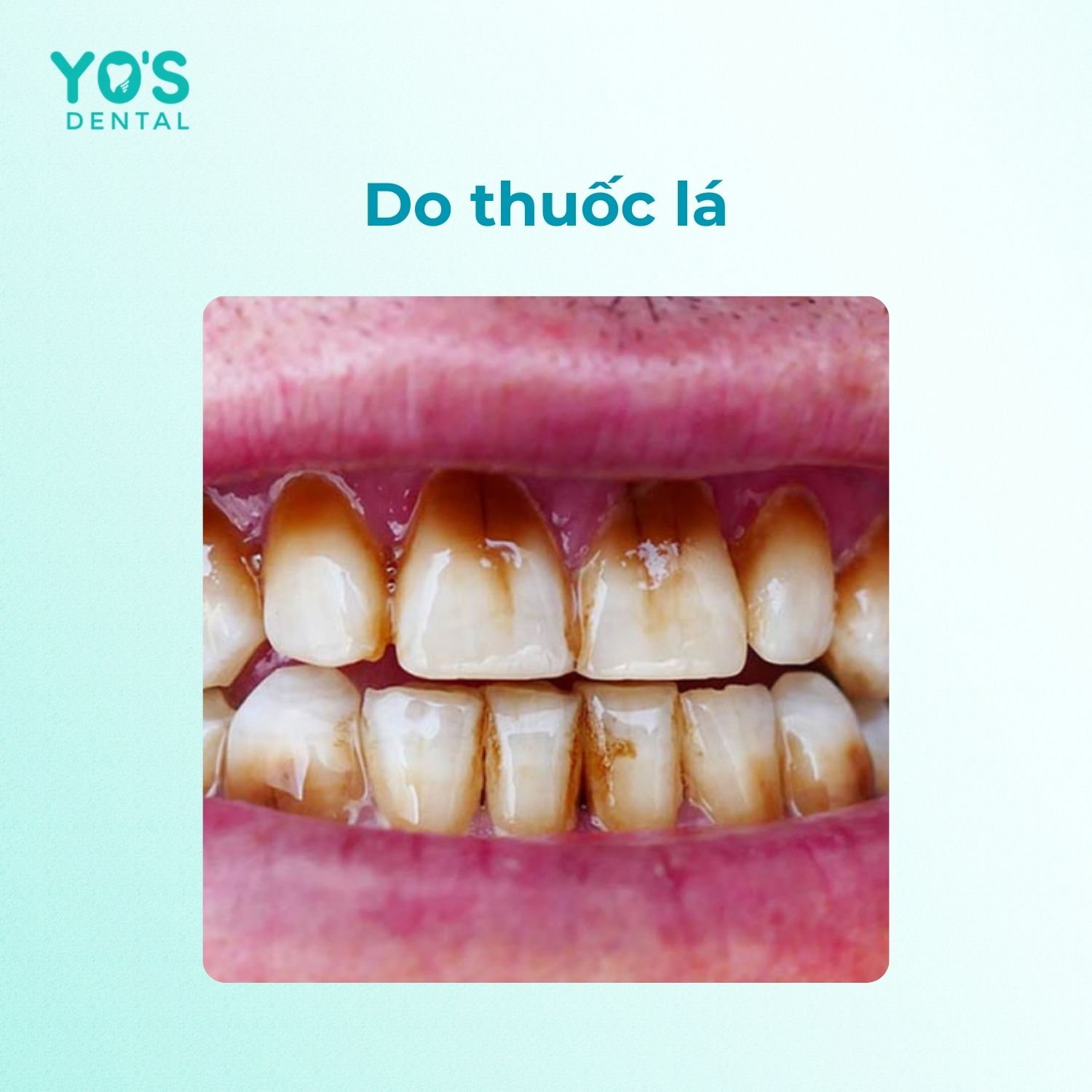 Chân răng bị đen do thuốc lá