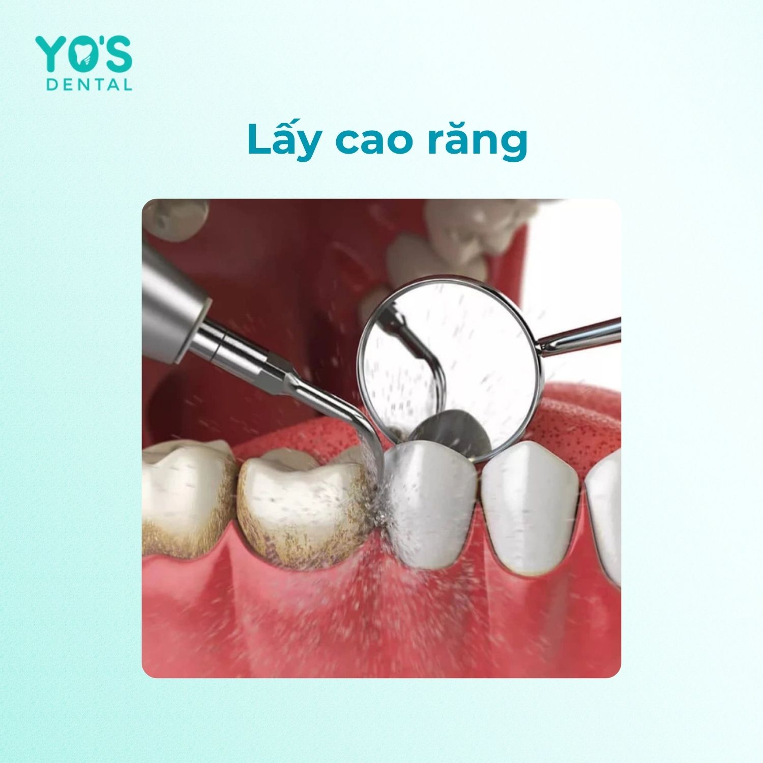 Trị viêm chân răng bị đen bằng cách lấy cao răng