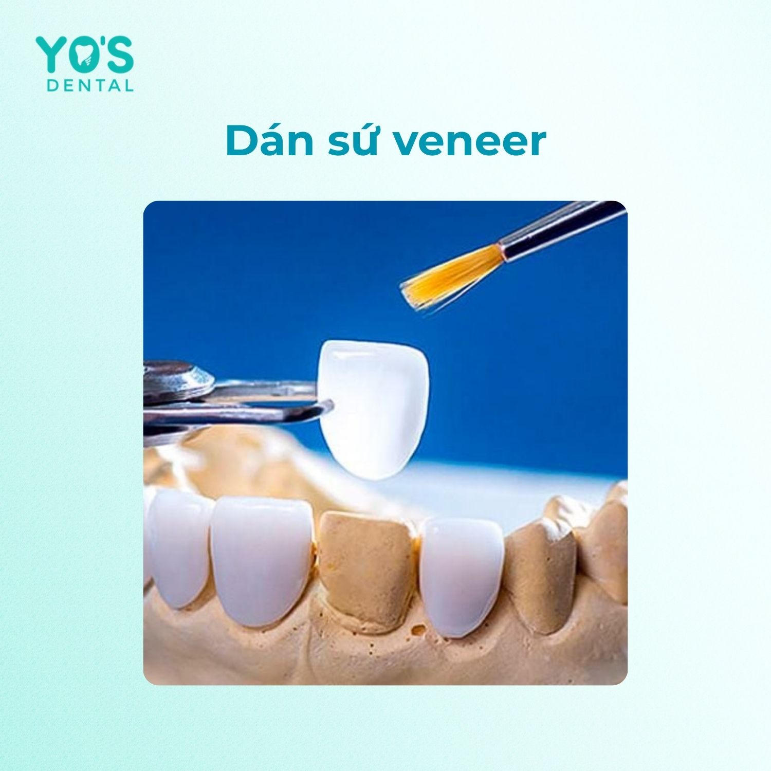 Trị viêm chân răng bị đen bằng dán sứ veneer