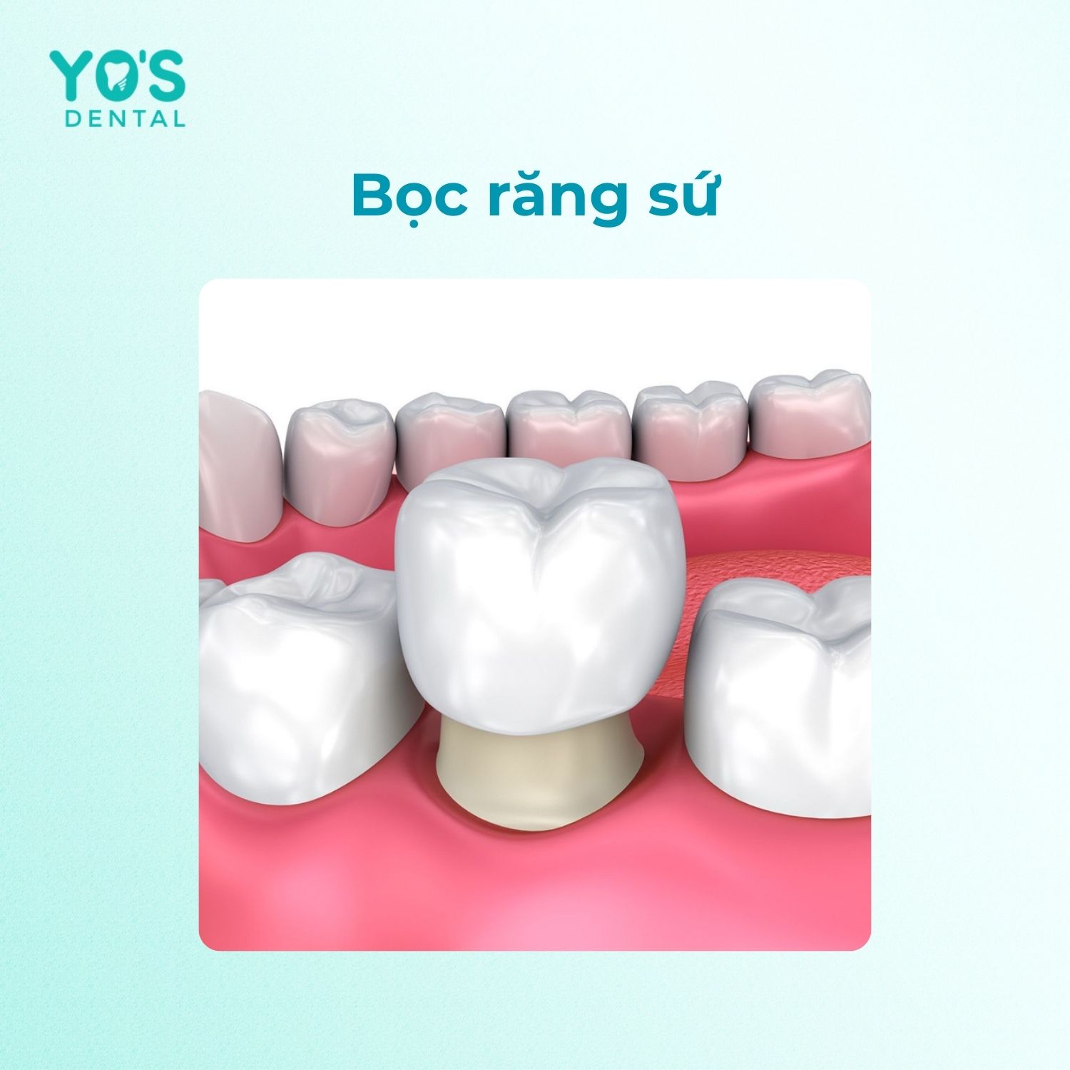 Trị viêm chân răng bị đen bằng bọc răng sứ