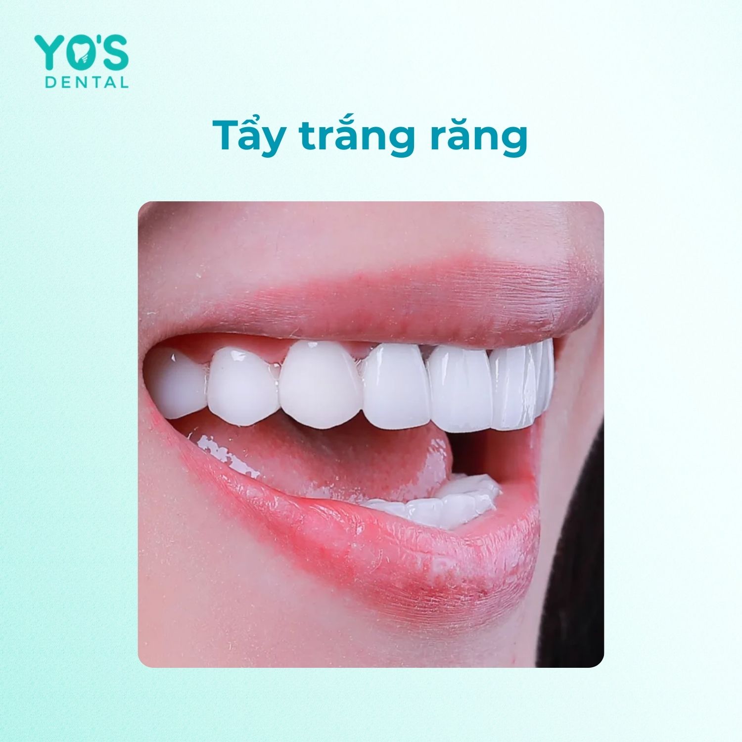 Trị viêm chân răng bị đen bằng cách tẩy trắng răng