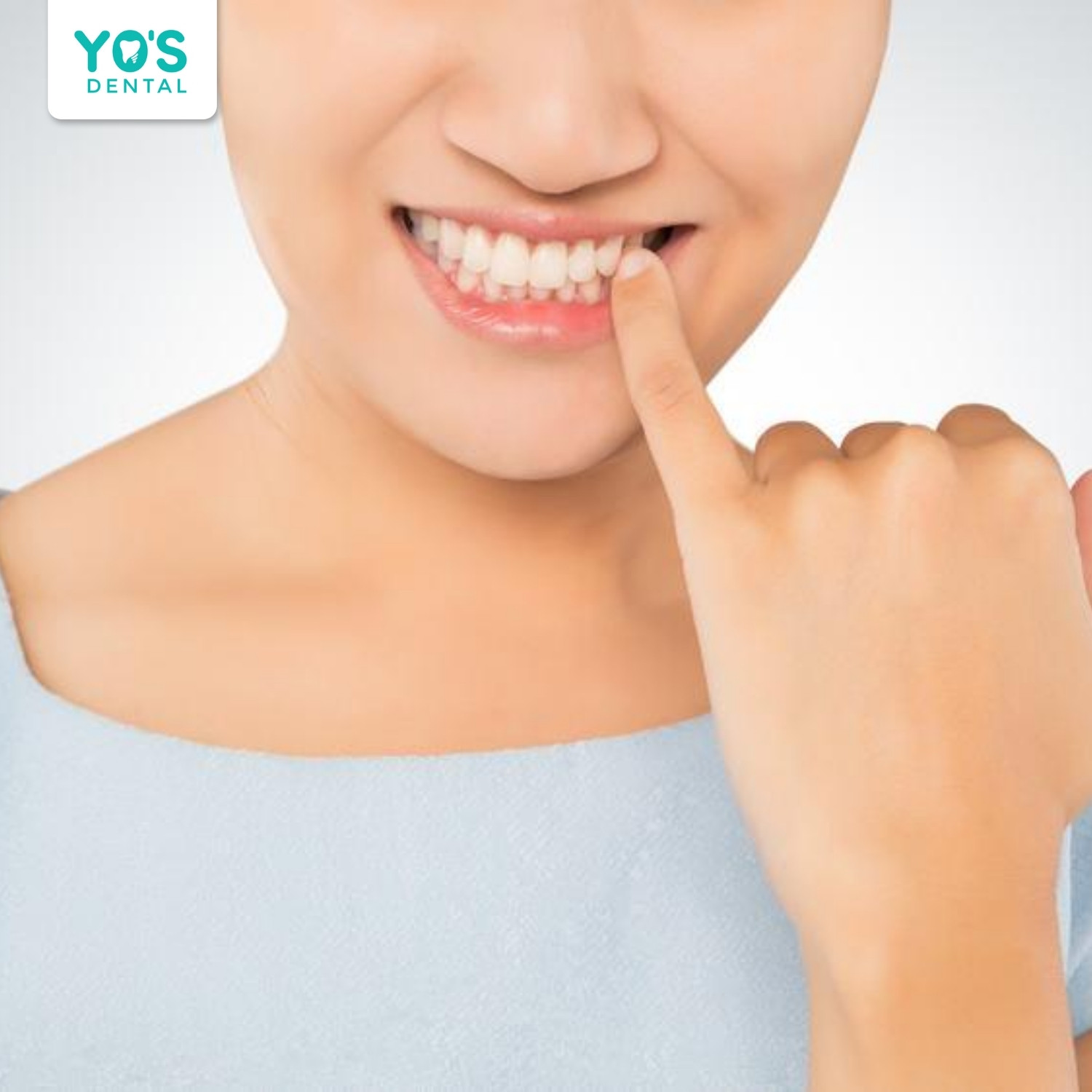 Thức ăn dễ mắc vào kẽ răng hơn răng thật