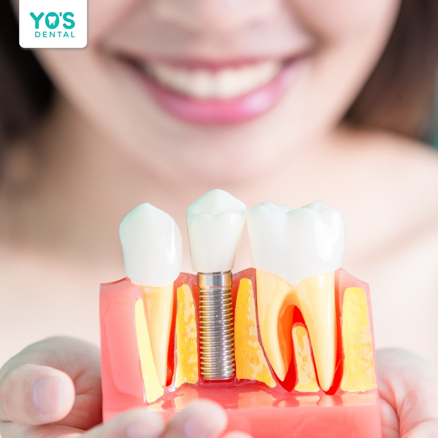 Trồng răng Implant mang lại nụ cười tự tin