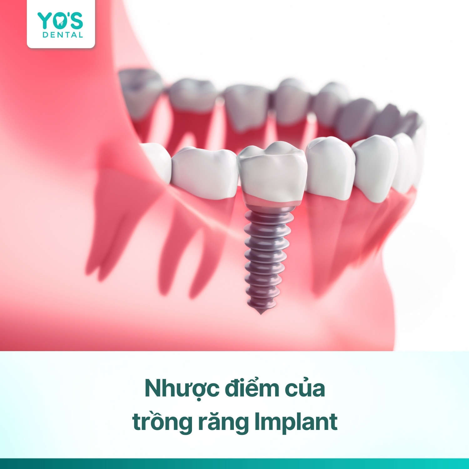 9 nhược điểm của trồng răng Implant và lời khuyên từ chuyên gia