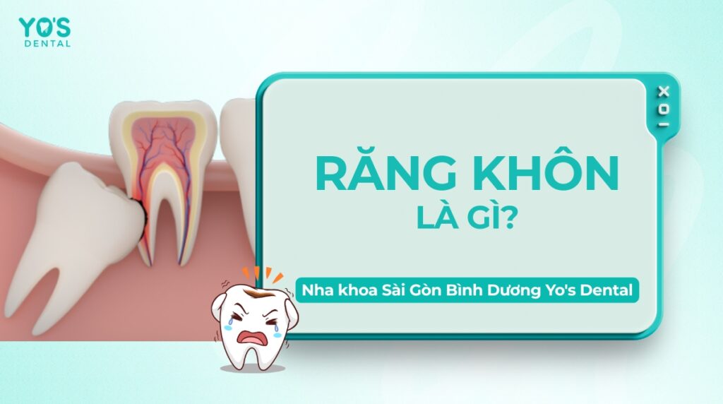 Răng khôn có mấy loại