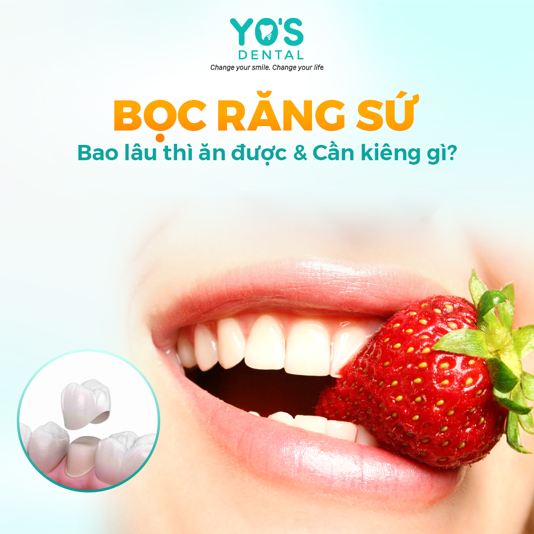 Bọc răng sứ bao lâu thì ăn được & Cần kiêng gì?