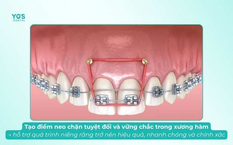 Bắt vít niềng răng giúp tạo điểm neo vững chắc, tăng hiệu quả niềng răng