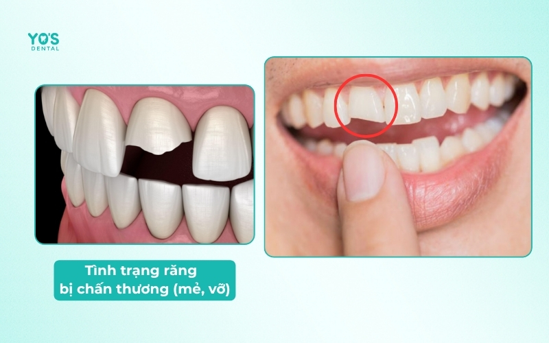 Tình trạng răng bị chấn thương (mẻ, vỡ) Tình trạng răng bị chấn thương (mẻ, vỡ)