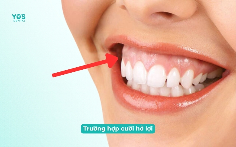 Trường hợp cười hở lợi