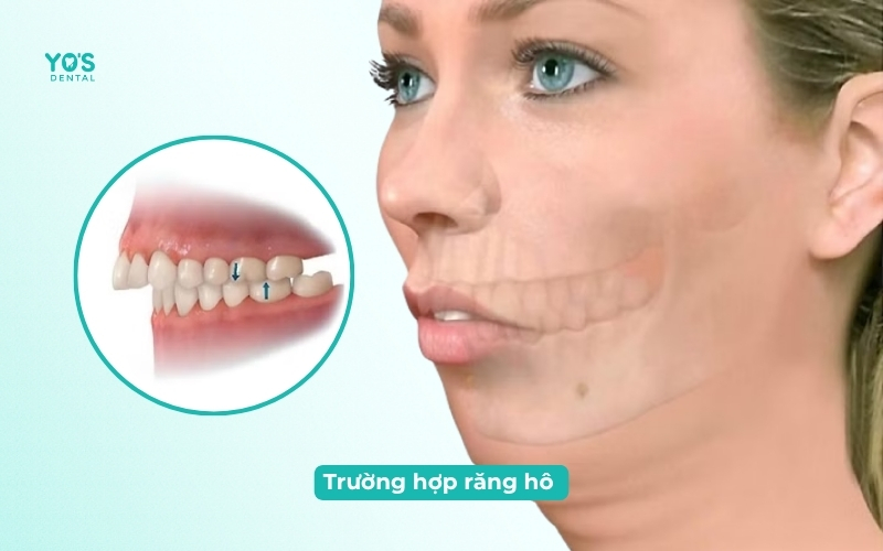 Trường hợp răng bị hô, vẩu