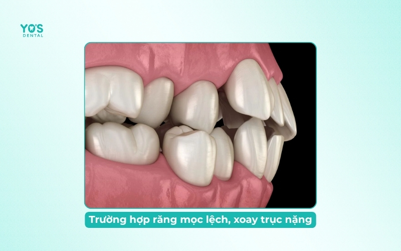 Trường hợp răng mọc lệch, xoay trục nặng