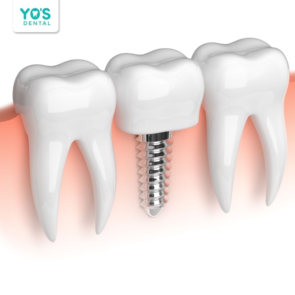 Hãy chăm sóc răng miệng đúng cách, duy trì vệ sinh đều đặn và thăm khám định kỳ để phòng ngừa bệnh lý tủy răng