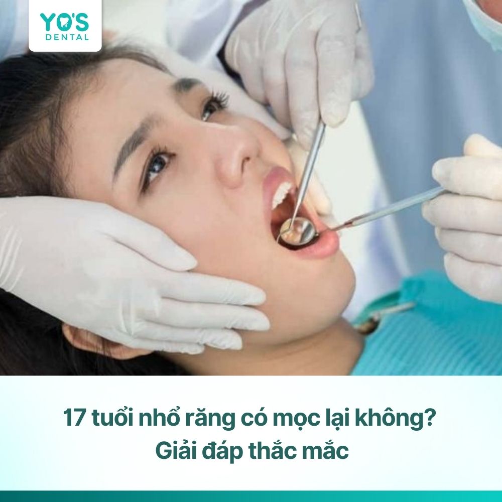 17 tuổi nhổ răng có mọc lại không? Giải đáp thắc mắc
