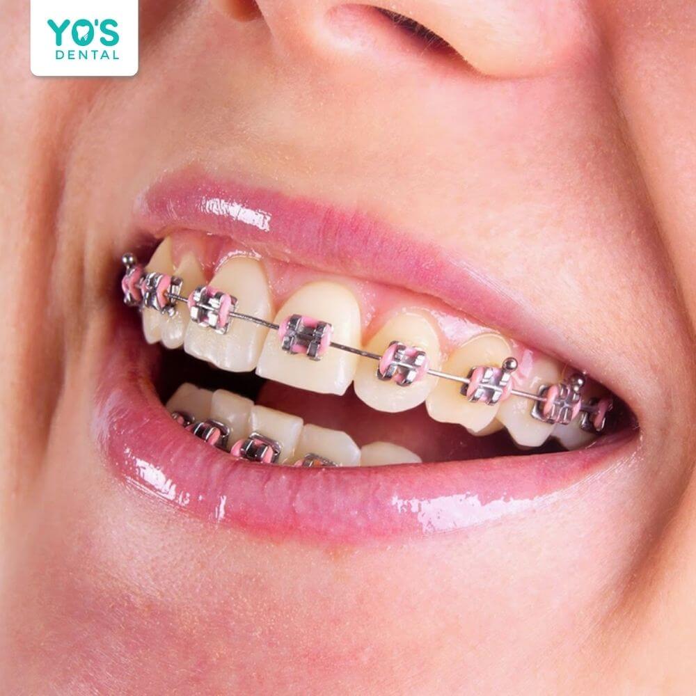 Niềng răng mắc cài kim loại vẫn hiệu quả với đa số lứa tuổi, kể cả người trung niên