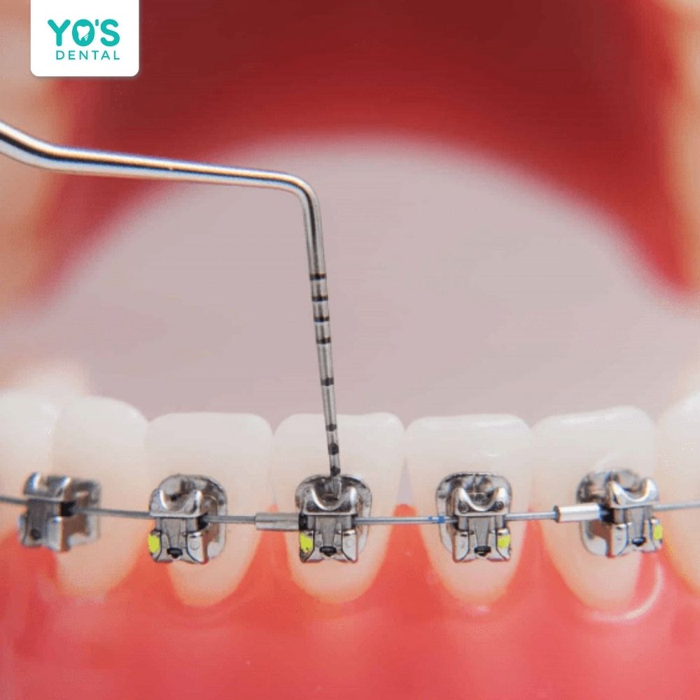 Niềng răng mắc cài tự động là phương pháp tối ưu cho việc chỉnh nha
