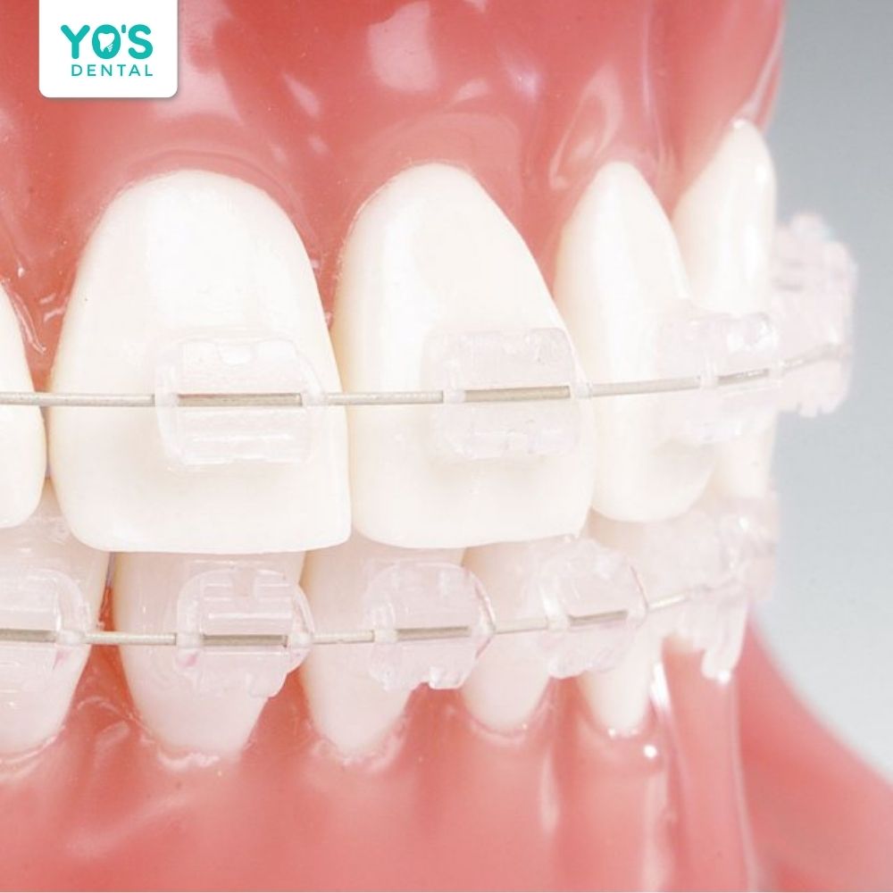 Niềng răng mắc cài sứ vừa mang lại kết quả tốt vừa đảm bảo tính thẩm mỹ với người trưởng thành
