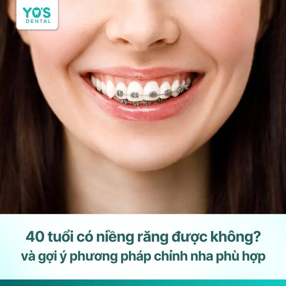 40 tuổi có niềng răng được không?