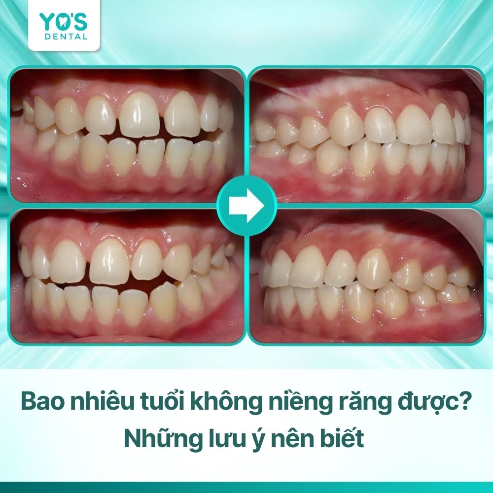 Bao nhiêu tuổi không niềng răng được? Những lưu ý nên biết
