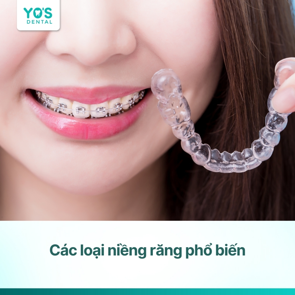 Các loại niềng răng phổ biến