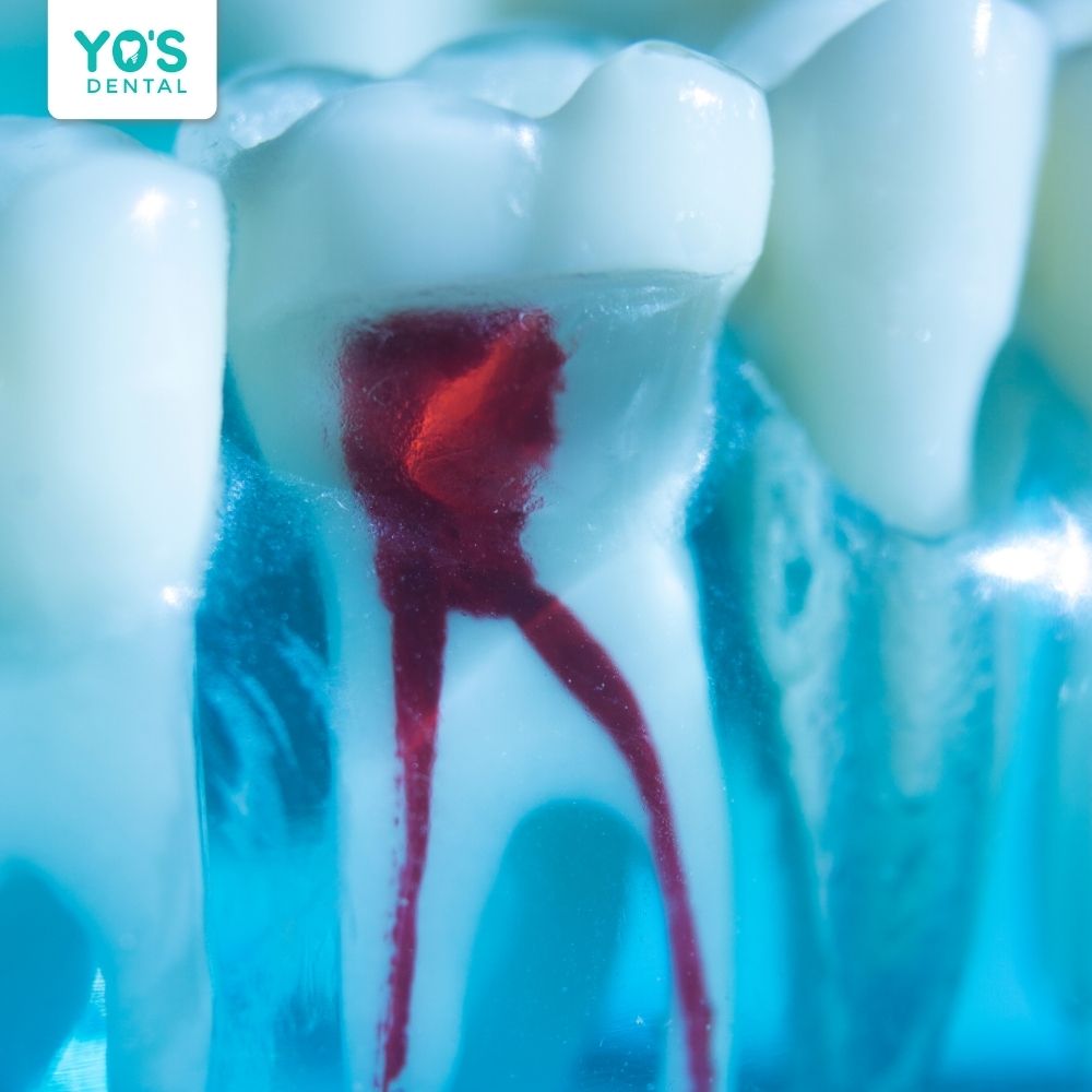Viêm tủy răng sữa khá phổ biến ở trẻ em