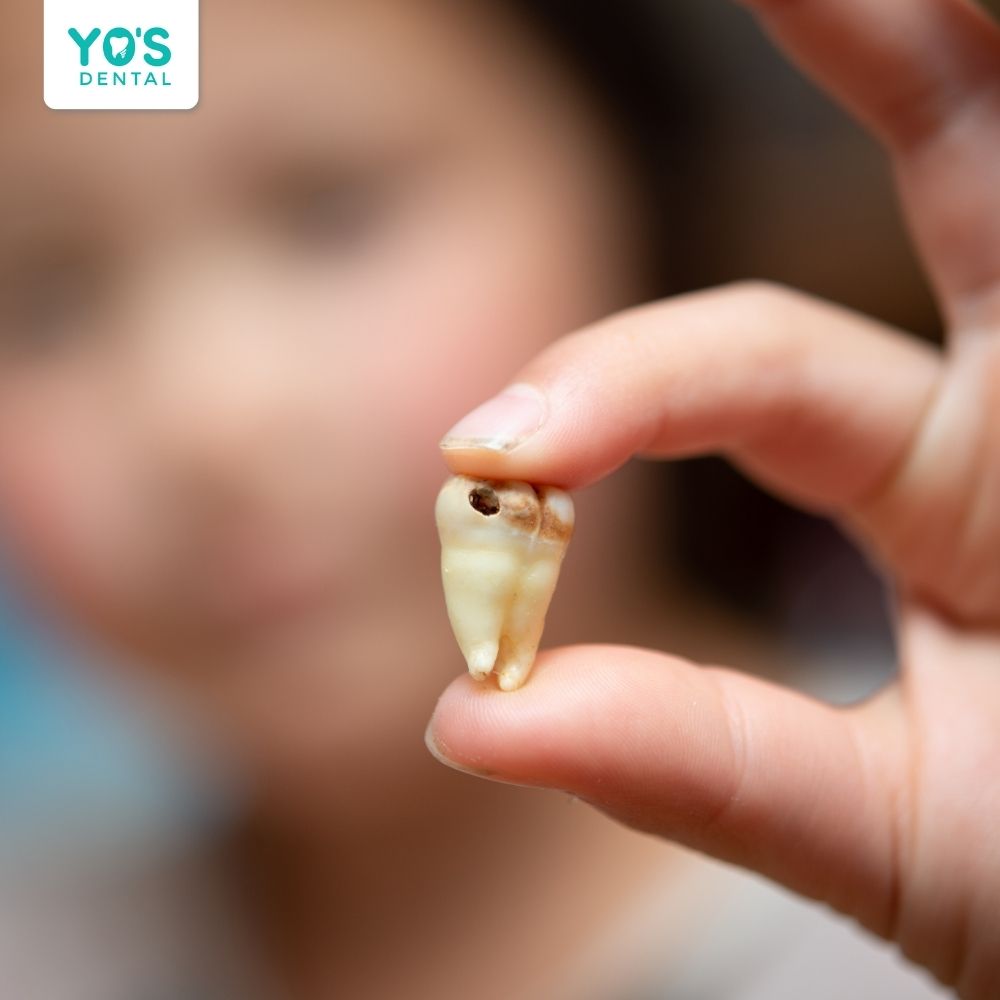 Có rất nhiều nguyên nhân khiến viêm tủy răng ở trẻ em