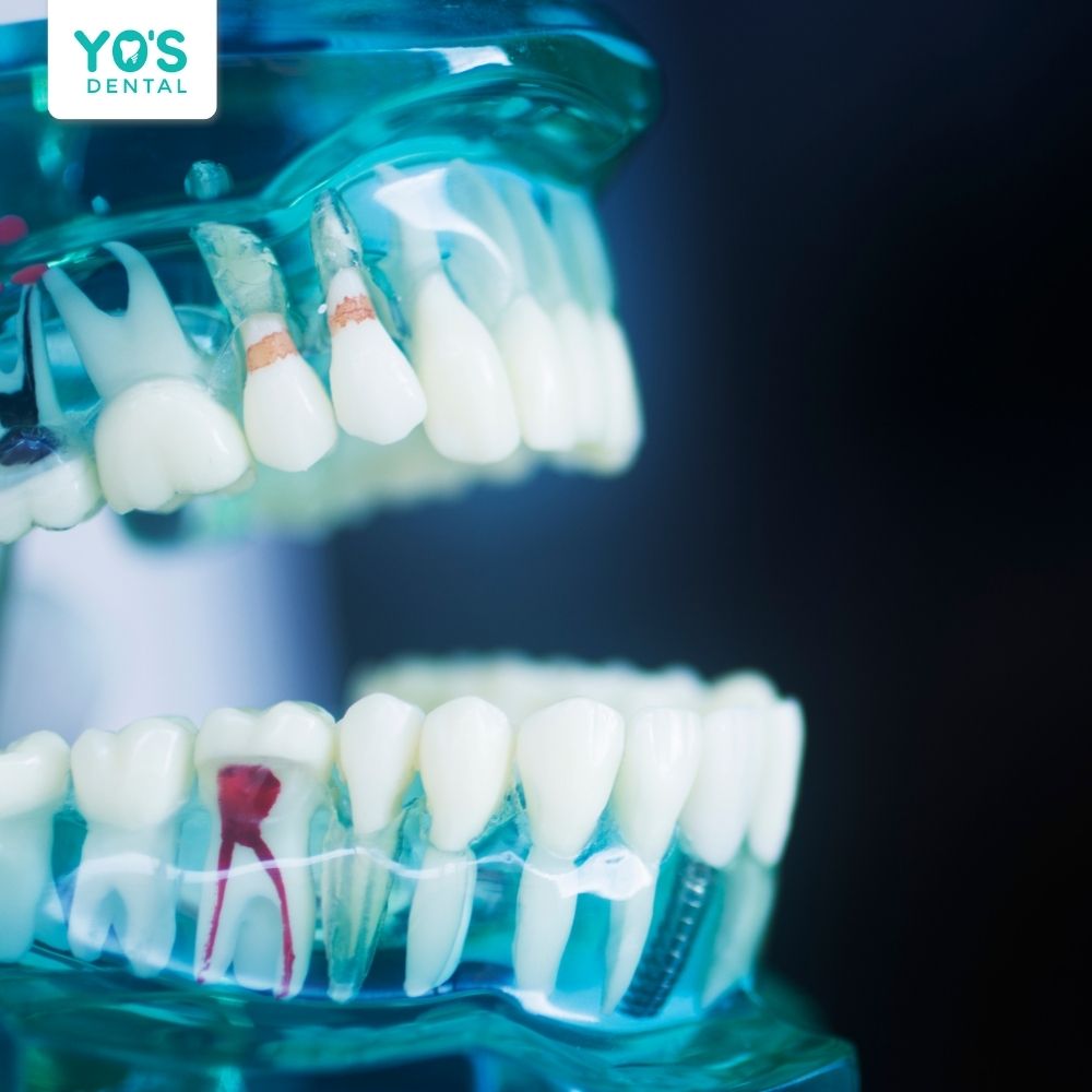 Viêm tủy răng ở trẻ được phân loại theo mức độ và theo giai đoạn