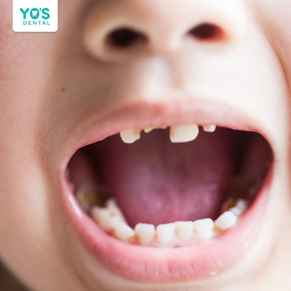 Viêm tủy răng ở trẻ em tiềm ẩn nhiều nguy cơ ảnh hưởng đến sức khỏe răng miệng và toàn thân