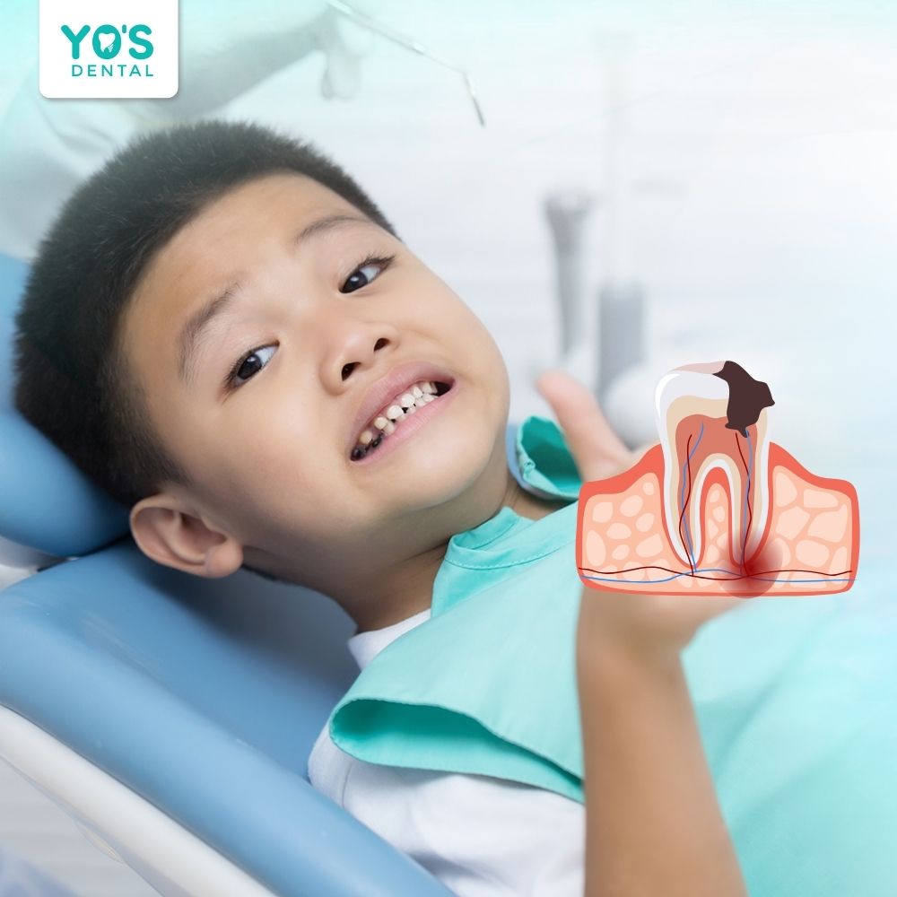 Viêm tủy răng sữa có thể phục hồi và không phục hồi