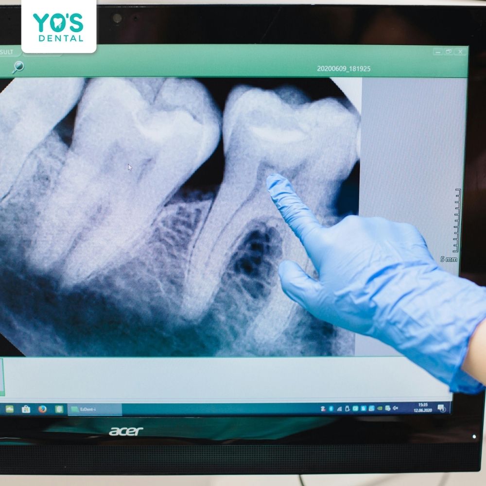 Các biện pháp phòng ngừa viêm tủy răng hiệu quả cho trẻ