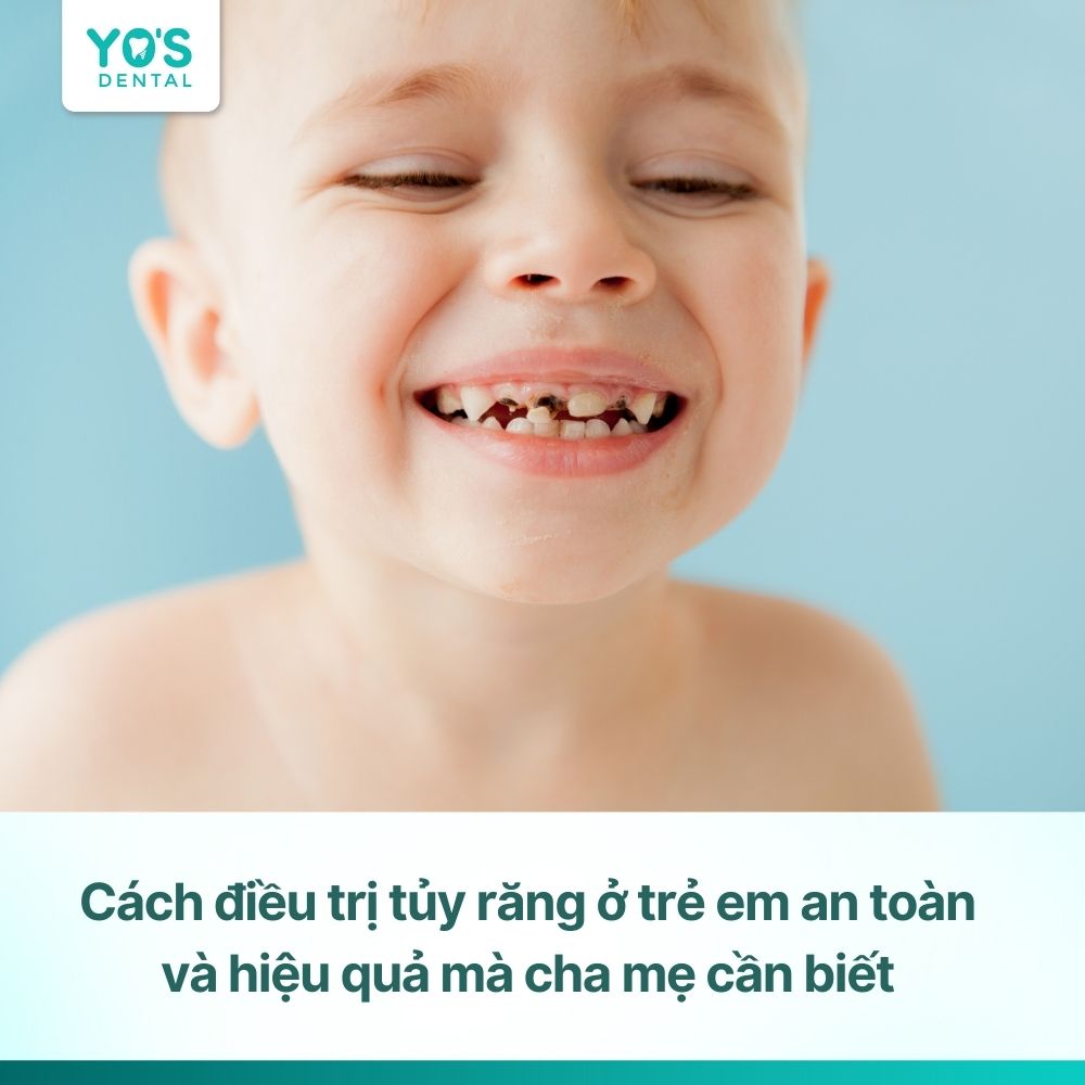 Cách điều trị tủy răng ở trẻ em an toàn và hiệu quả mà cha mẹ cần biết
