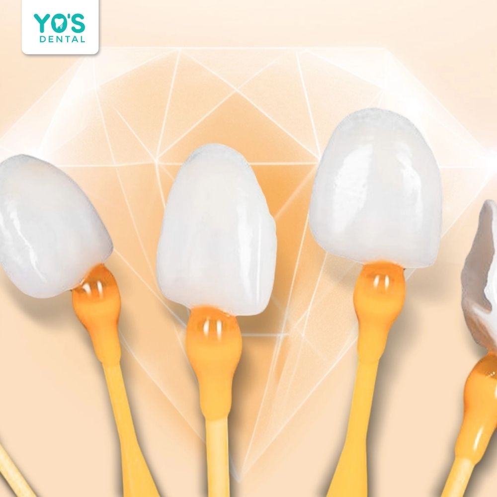 Veneer Lingual ít bị đổi màu sau thời gian sử dụng