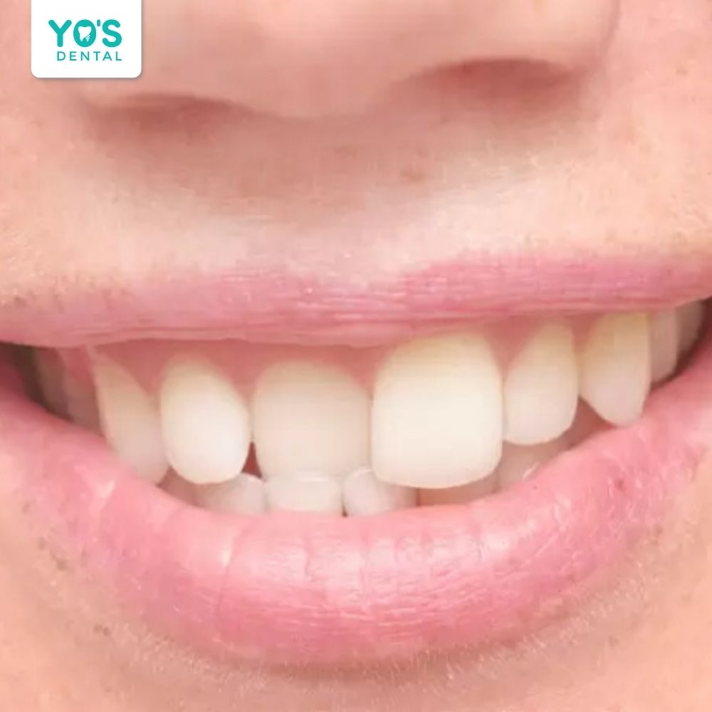Veneer nha khoa cải thiện tình trạng răng thưa, răng lệch lạc