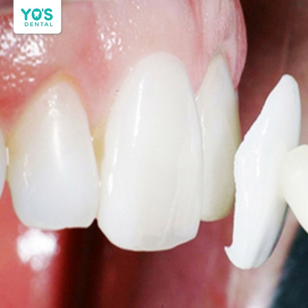 Miếng dán sứ Veneer có độ bền cao nếu chăm sóc đúng kỹ thuật